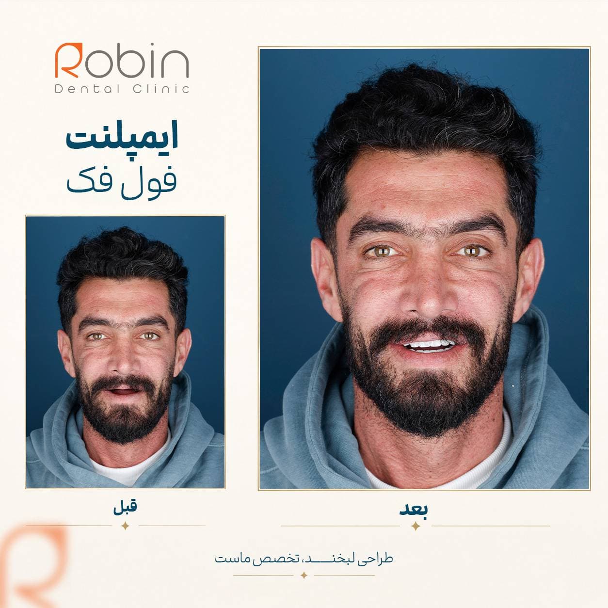 قبل و بعد ایمپلنت فول فک — بیمار مرد جوان