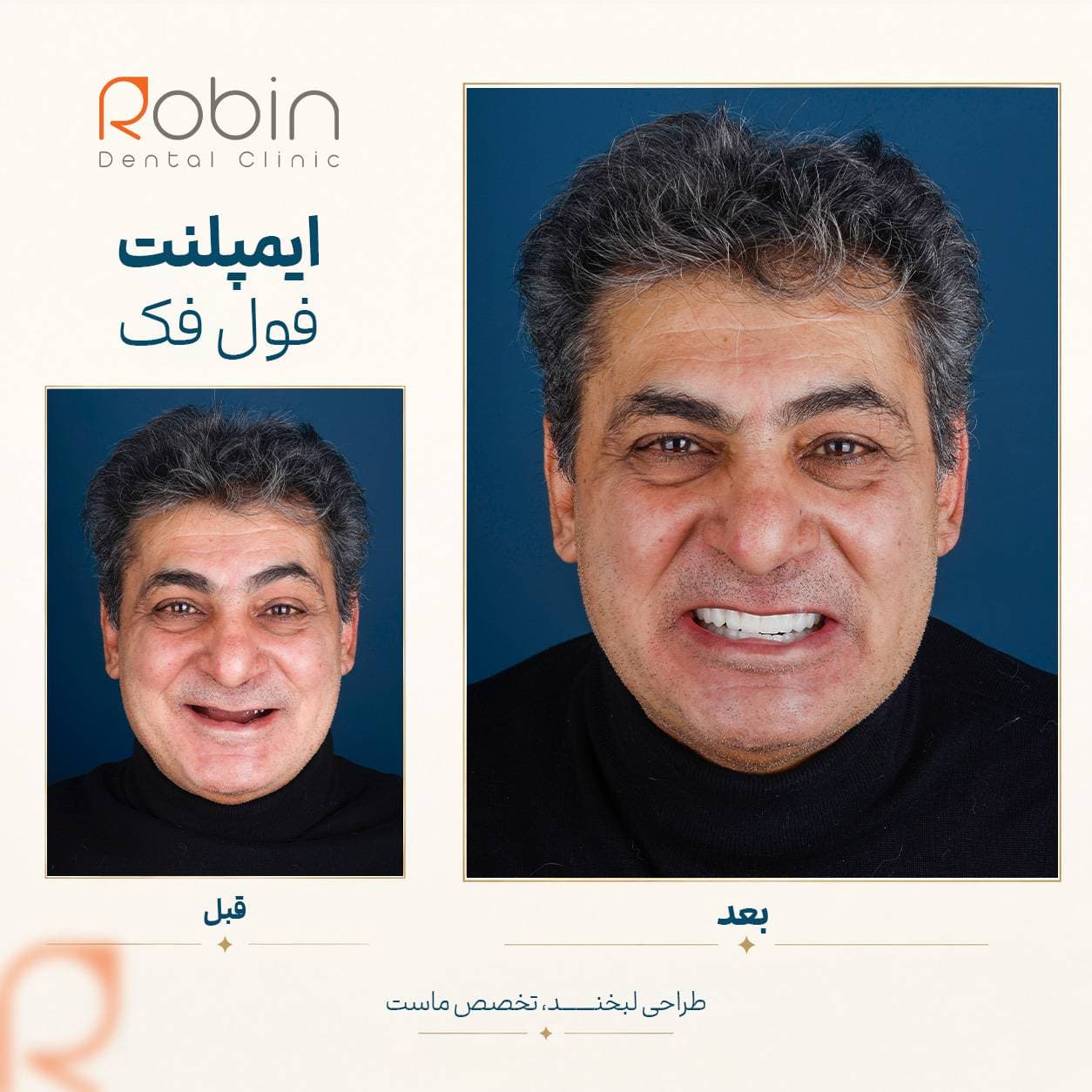 قبل و بعد ایمپلنت فول فک — بیمار مرد