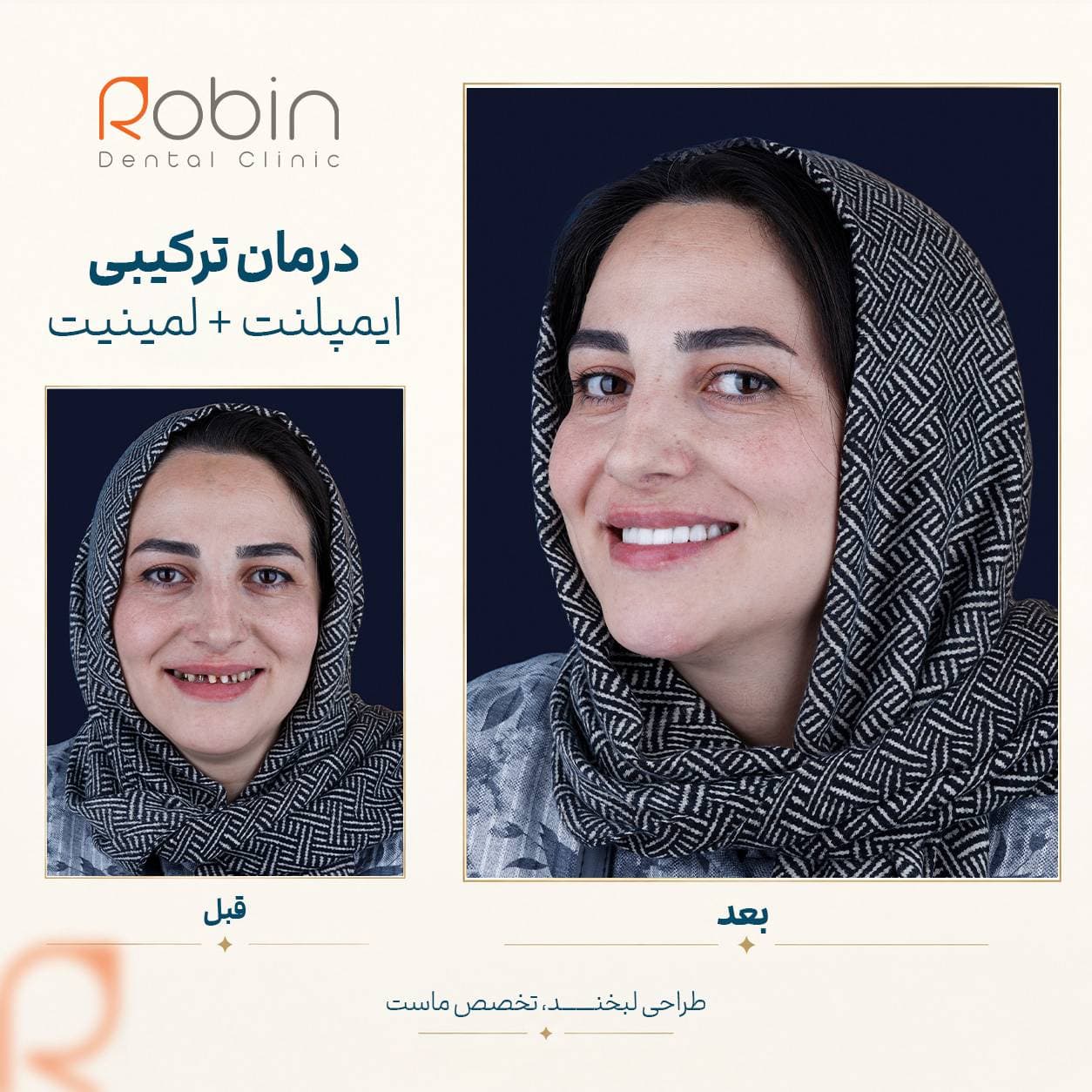 قبل و بعد درمان ترکیبی ایمپلنت و لمینت